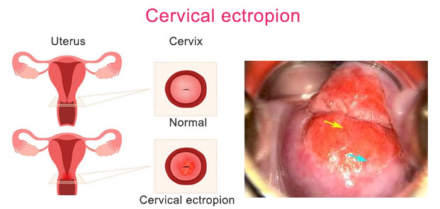 Cervical Ectropion