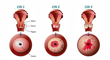 Cervical Intraepithelial Neoplasia