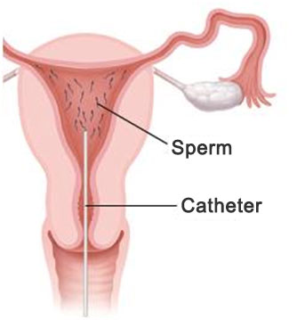IUI – Intrauterine Insemination