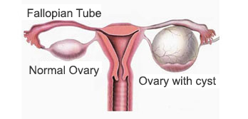 Ovarian Cyst