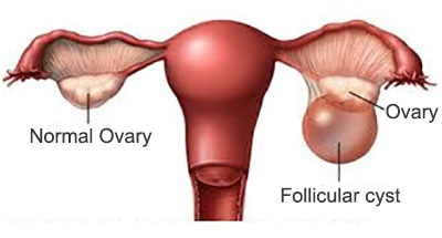 Ovarian Cyst