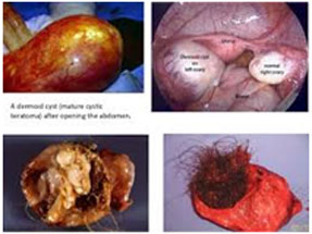 Dermoid cysts