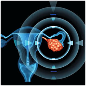 Ovarian Tumor