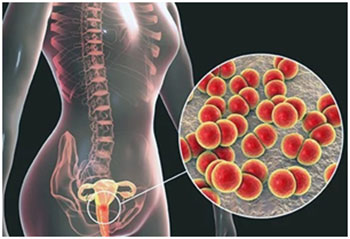 Pelvic Inflammatory Disease