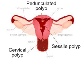 Uterine Polyp